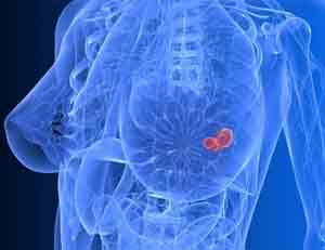 Findings raise the possibility of preventing breast cancer with statins