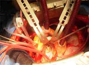 Stem cells from fat removed during cardiac surgery are cardioprotective