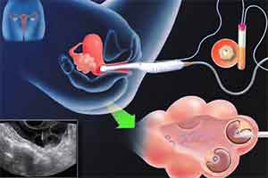 ivf1