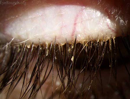 Page 17 18 Figure 2 Anterior blepharitis with collarettes source eyerounds.org