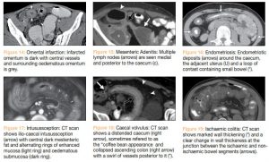 Imaging Right Iliac Fossa (RIF) Pain - TheSynapse
