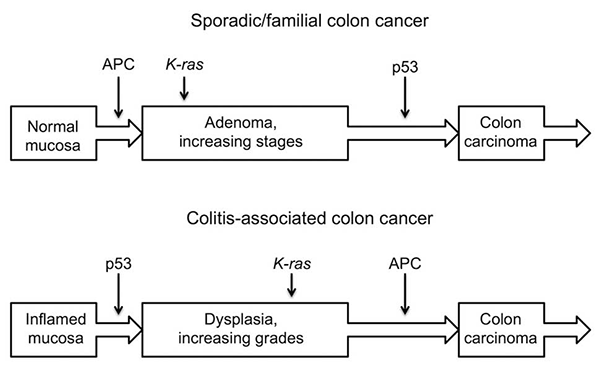 Figure 3 Major steps of sporadic/familial and colitis associated colon cancer formation