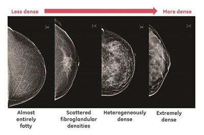 Scattered Fibroglandular Densities