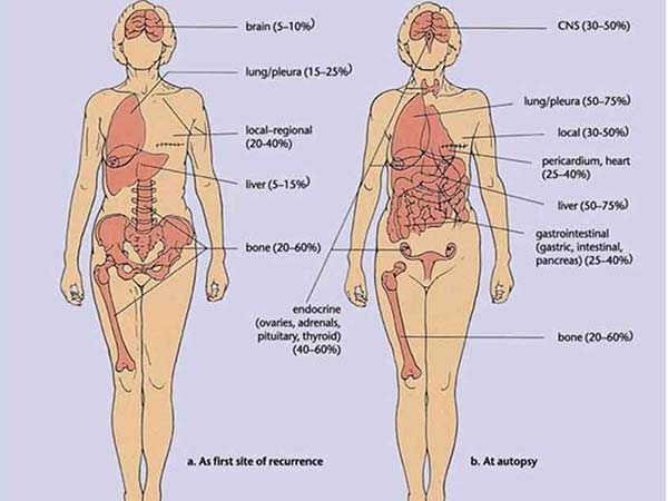 Breast cancer's spread routes mapped - myCME