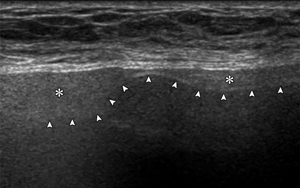 Imaging Breast Implant Rupture - TheSynapse
