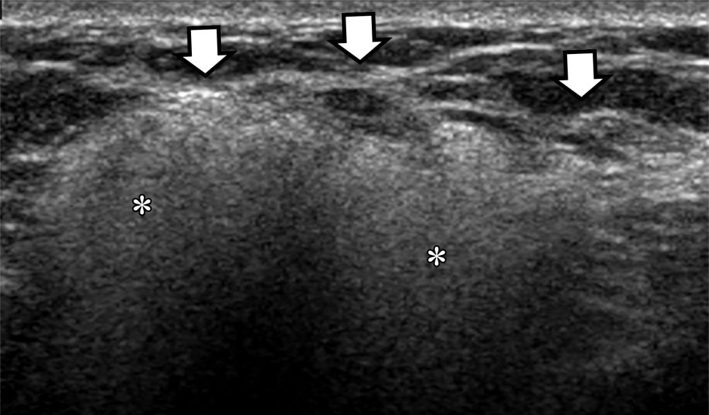 Imaging Breast Implant Rupture - TheSynapse