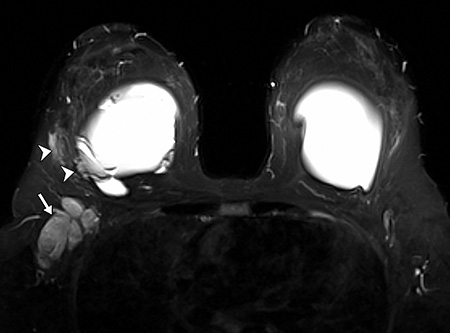 Silicone gel-filled implants. T2-weighted (a), silicone-only (b), and