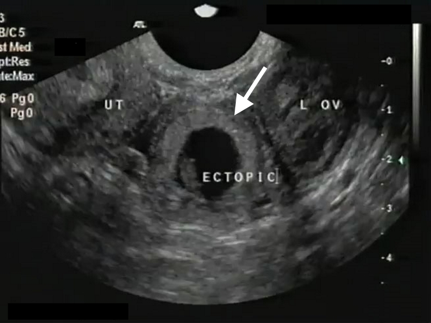 Ultrasound Diagnosis and Management of Ectopic Pregnancy - myCME